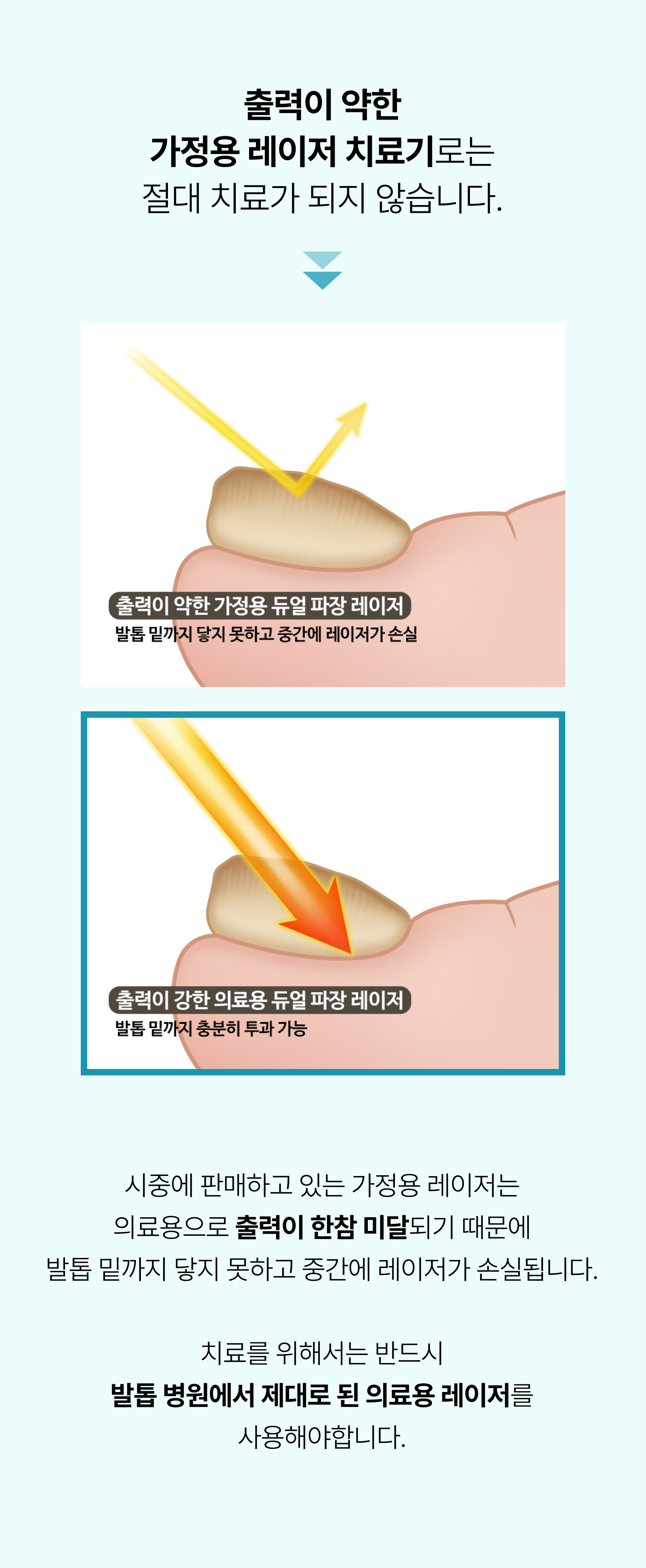 르샤인의원 문제성 발톱 클리닉