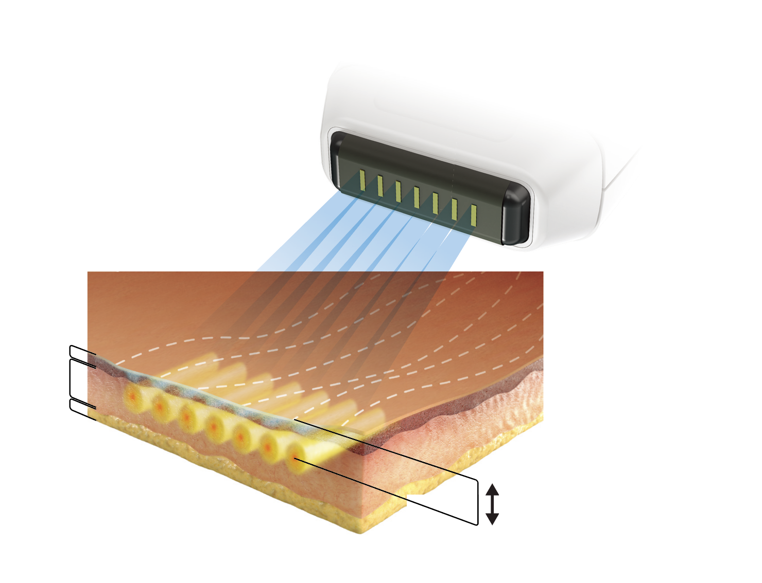 소프웨이브 피부 깊이 다이어그램