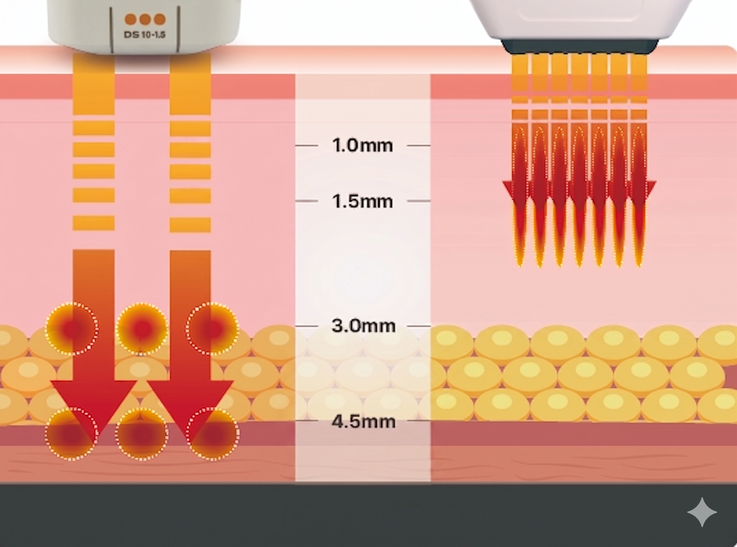 HIFU vs 소프웨이브 비교